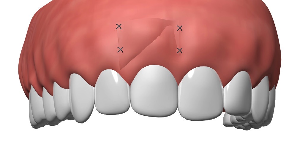 Cabinet dentaire Nimes Implant dentaire